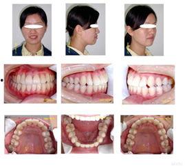 成人磨牙拔牙视频教程,成人磨牙拔牙操作步骤详解视频教程