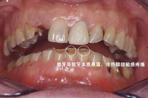 成人磨牙拔牙视频教程,成人磨牙拔牙操作步骤详解视频教程