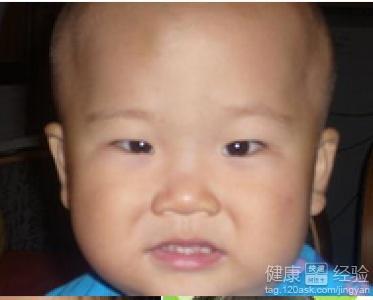 成人怎么做近视手术视频,成人如何安全摘镜